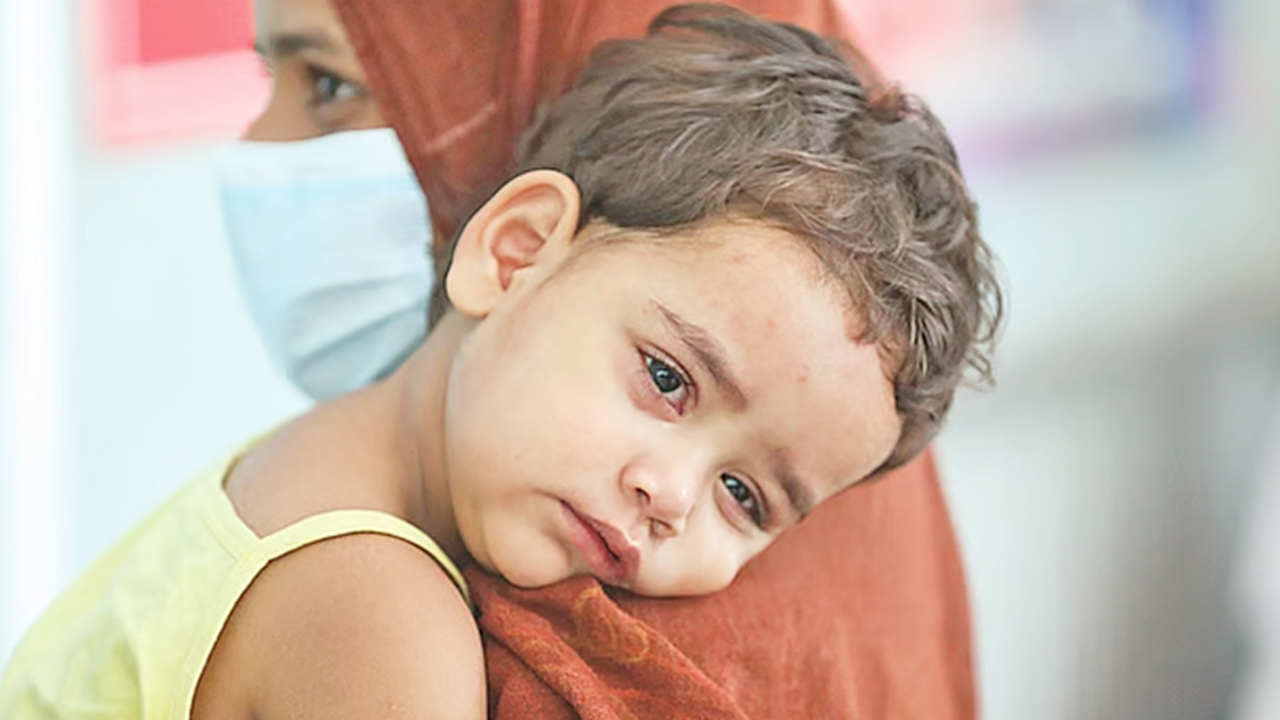 ২৪ ঘণ্টায় হামে আরও ৩ মৃত্যু, আক্রান্ত ৯৪৭