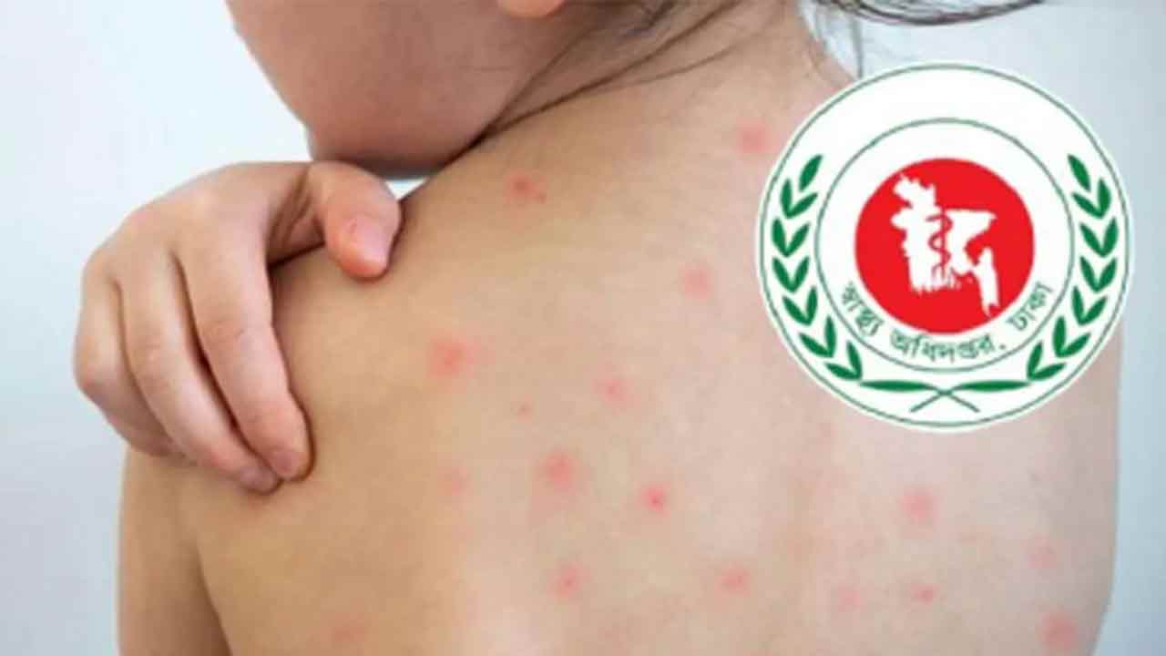 দেশে ২৪ ঘণ্টায় হামে আরও ২ শিশুর মৃত্যু