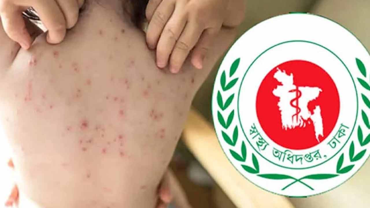 হামের উপসর্গ নিয়ে আরও ৪ শিশুর মৃত্যু