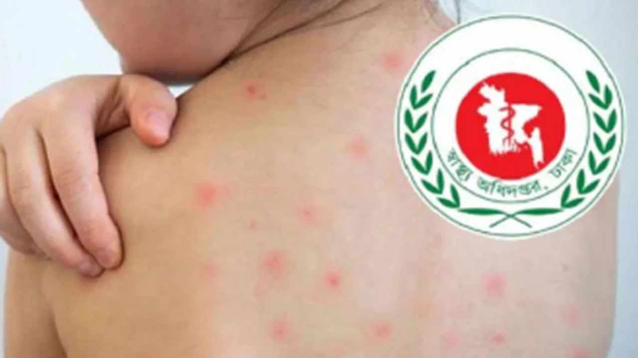 হাম ও হামের উপসর্গ নিয়ে আরও ১০ জনের মৃত্যু