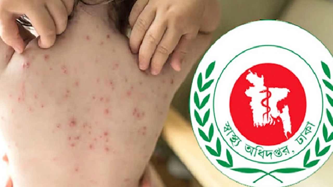 হাম ও হামের উপসর্গে আরও ১২ শিশুর মৃত্যু