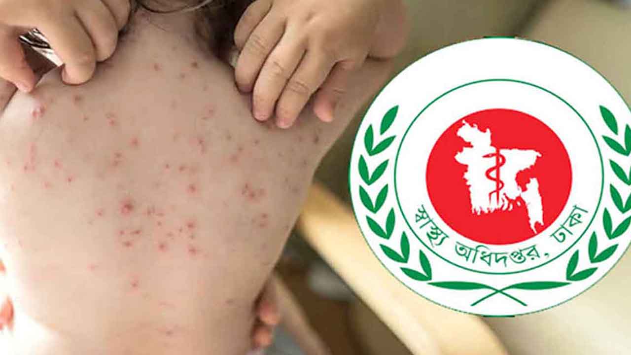 হাম ও উপসর্গে আরও ৭ জনের মৃত্যু