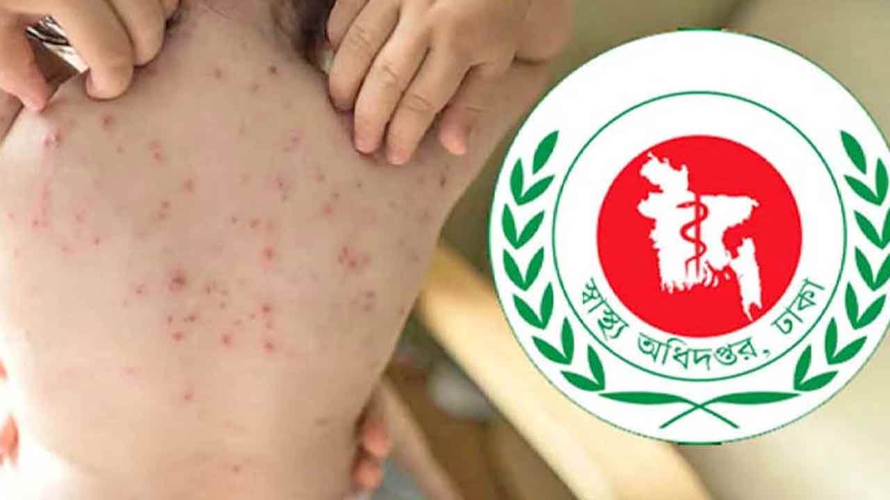 ২৪ ঘণ্টায় হাম উপসর্গে আরও ১৭ শিশুর মৃত্যু