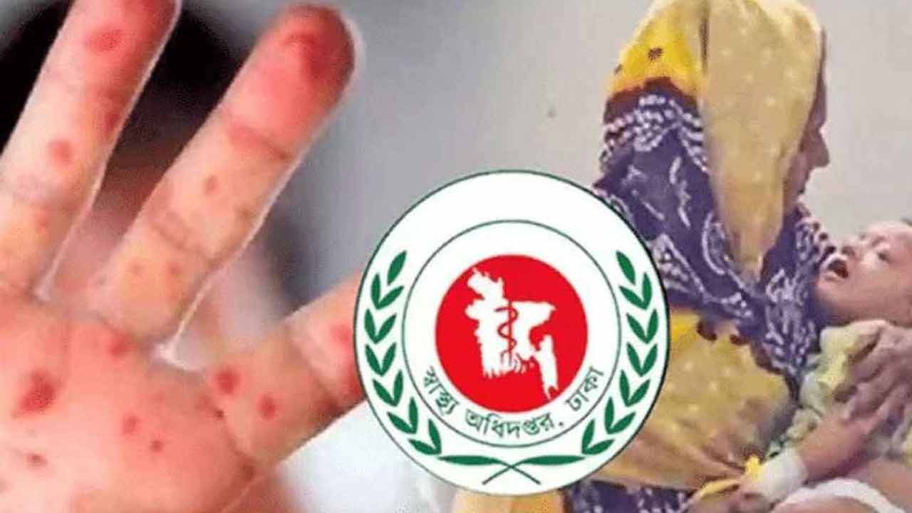 হামের উপসর্গে আরও ৫ শিশুর মৃত্যু
